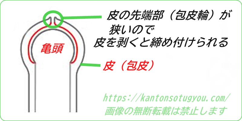 カントン包茎や包皮輪狭窄の原因を説明する図